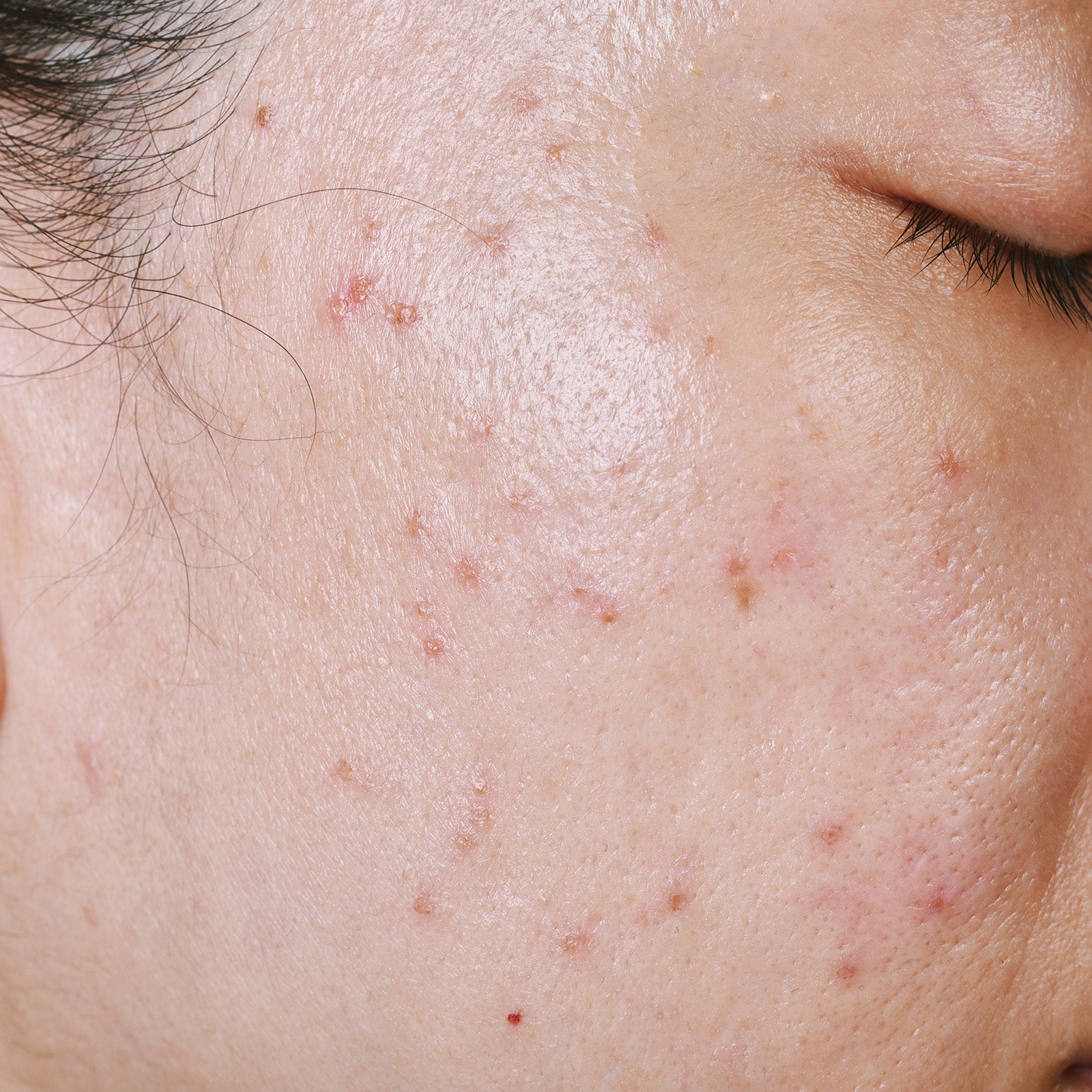 Acne-Prone ARWIN BIOCHEM